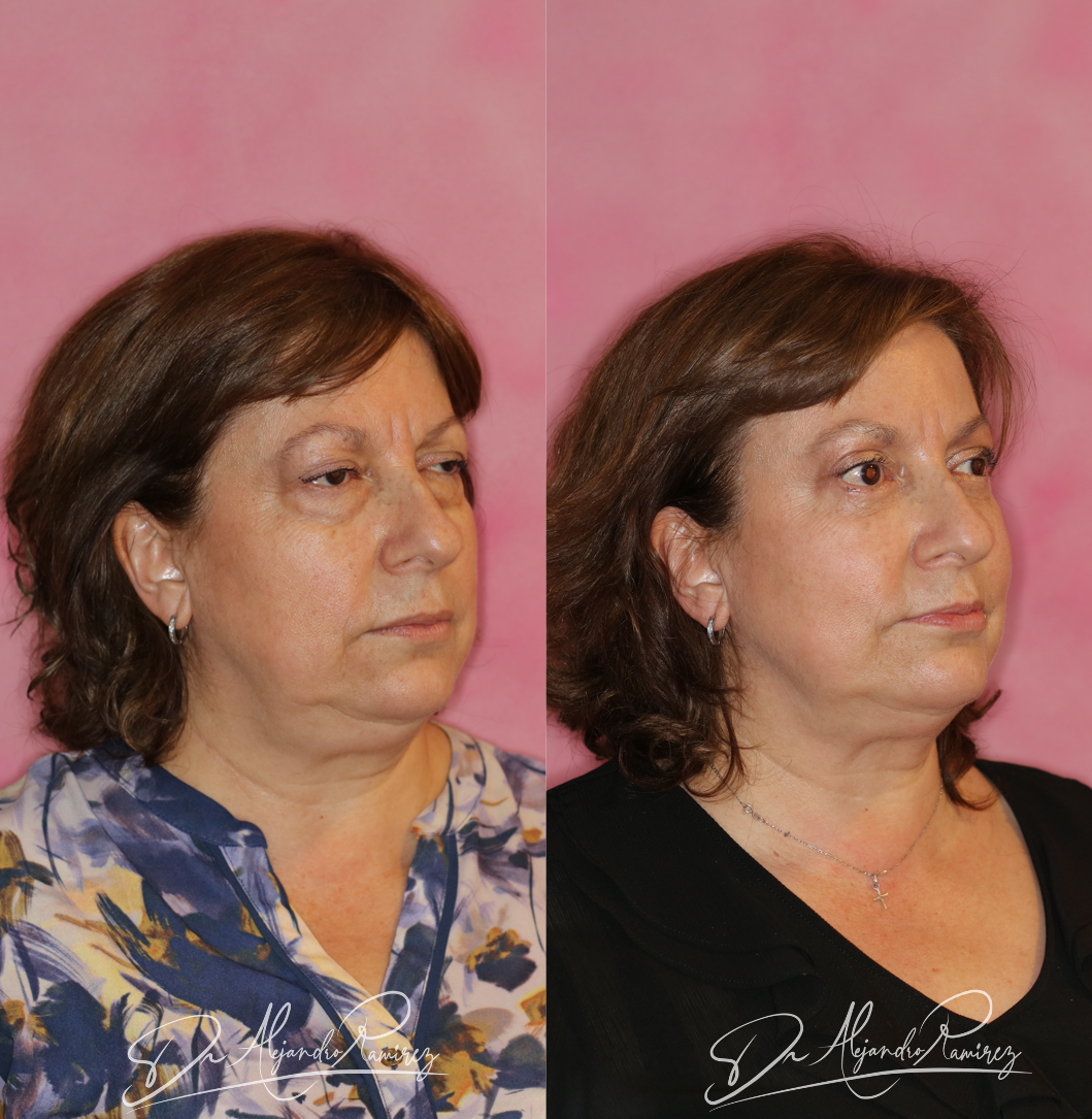 Brow & Eyelid Lift