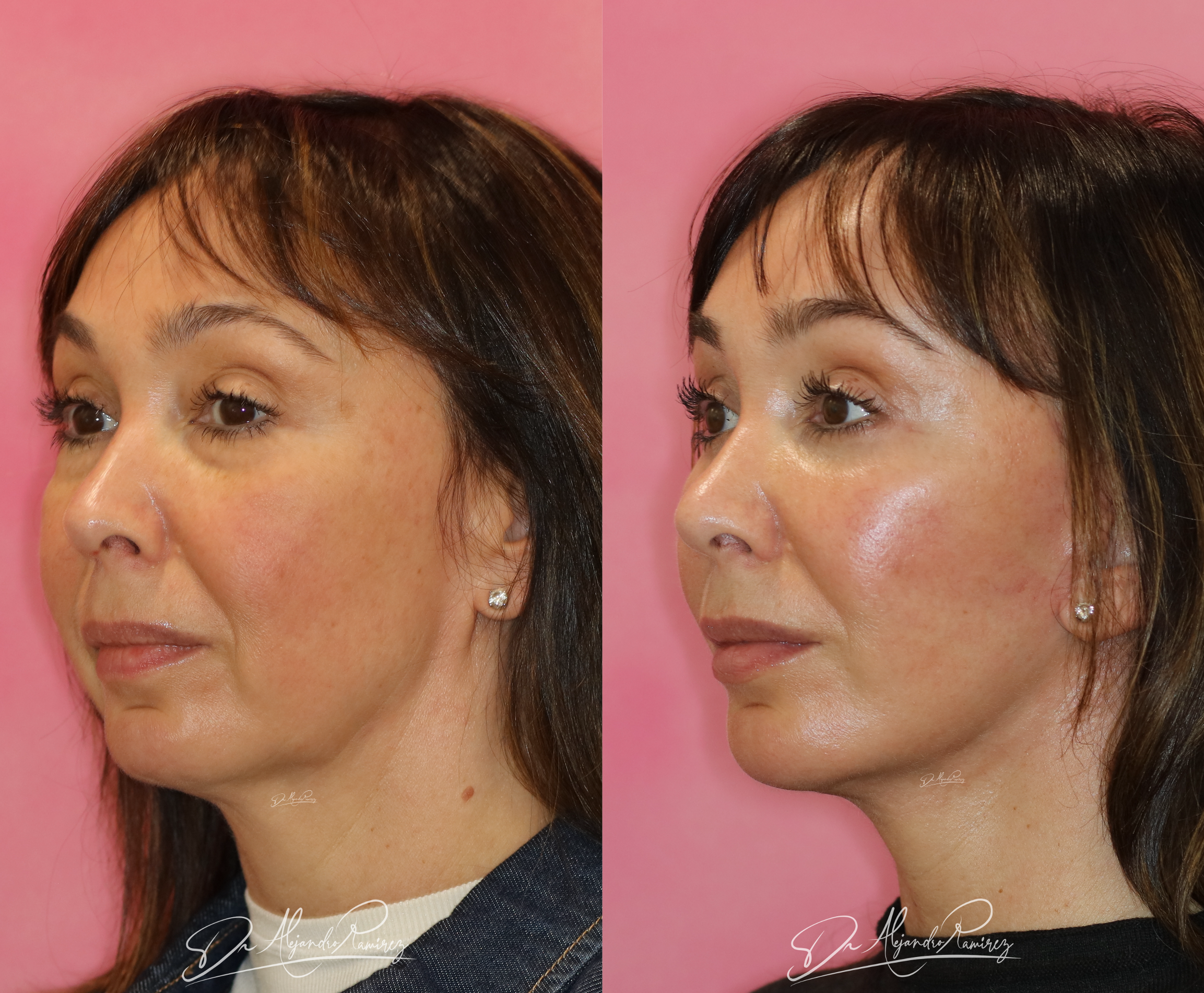 Deep-Plane Facelift