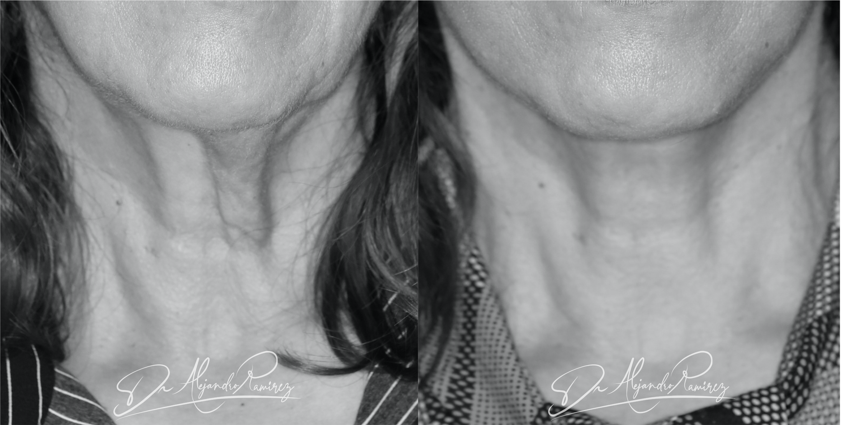 Neck Lift