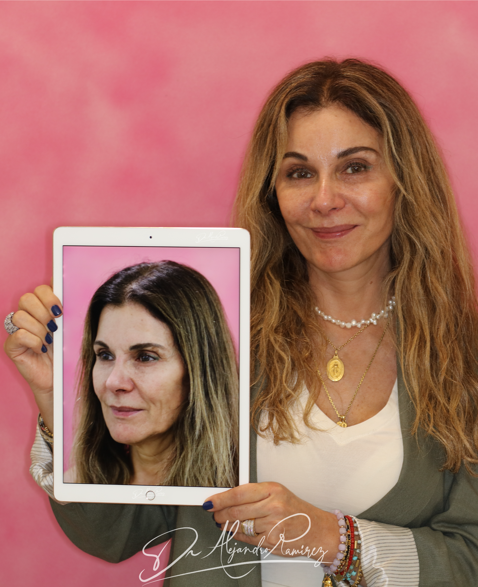 Claudia C. — Deep-plane facelift, 3 months